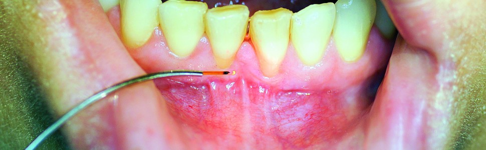Techniki cięcia tkanek miękkich za pomocą lasera diodowego w stomatologii