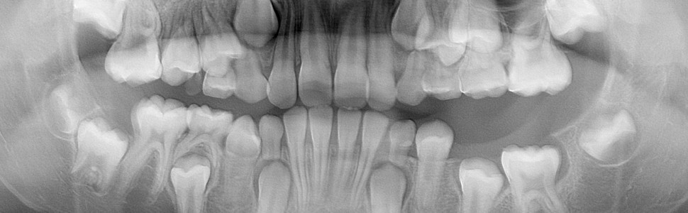 Zębiak złożony żuchwy przyczyną zatrzymania pierwszego zęba trzonowego stałego u dziewięciolatka – opis przypadku