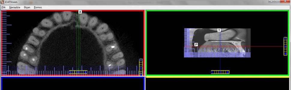 Wykorzystanie tomografii wolumetrycznej podczas ponownego leczenia kanałowego drugiego zęba przedtrzonowego szczęki