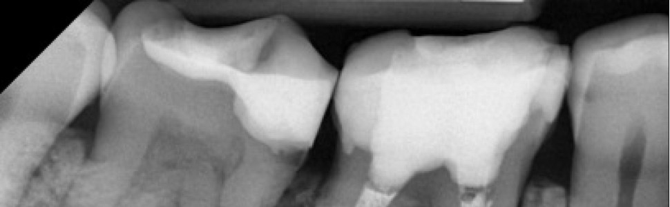 Laser diodowy o długości fali 810 nm w leczeniu endodontycznym