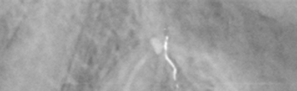 Zamknięcie rozległej perforacji z użyciem bioaktywnego materiału odtwórczego Activa – opis przypadku