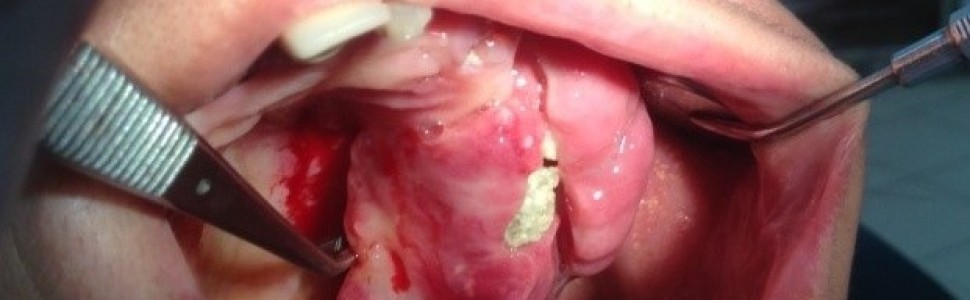 Włókniak kostniwno-kostniejący – opis przypadku