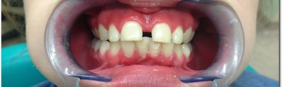Diastema – rutynowe leczenie czy wielkie wyzwanie ortodontyczne? Opis przypadku