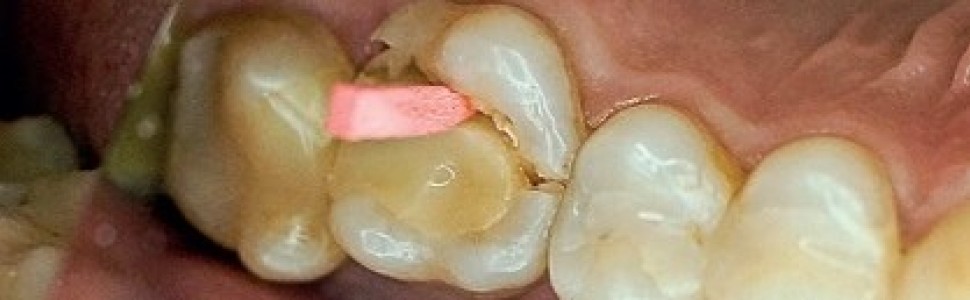 Adhezyjne uzupełnienia pośrednie w złamanych zębach bocznych – analiza problemu klinicznego