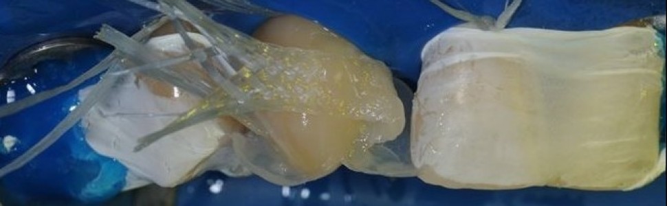 Kompozytowy most adhezyjny jako rozwiązanie alternatywne w przypadku braku możliwości leczenia kompleksowego