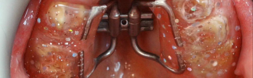 Leczenie ortodontyczne pacjentki z zespołem Marfana – opis przypadku