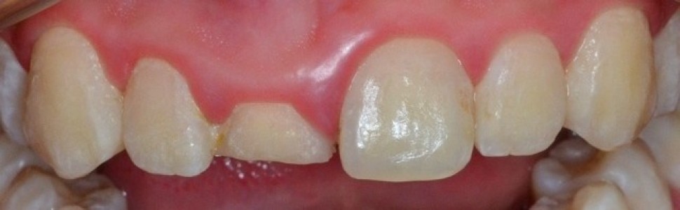 Wielospecjalistyczne leczenie estetyczne skośnego koronowo-korzeniowego złamania zęba siecznego przyśrodkowego – opis przypadku