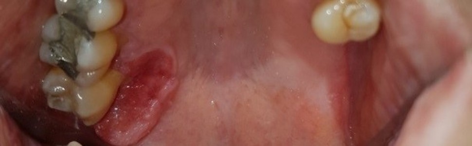 Czynnościowe kształtowanie pola protetycznego po częściowej resekcji szczęki zaopatrzonej przeszczepem tkankowym – opis przypadku