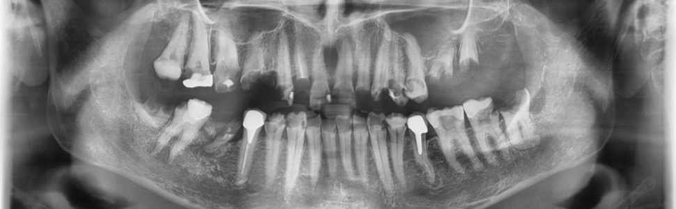 Interdyscyplinarne leczenie stomatologiczne pacjenta po radioterapii w obrębie głowy i szyi – opis przypadku