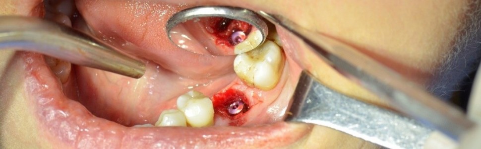 Implantacja natychmiastowa u pacjentki leczonej z powodu osteoporozy lekami z grupy bisfosfonianów