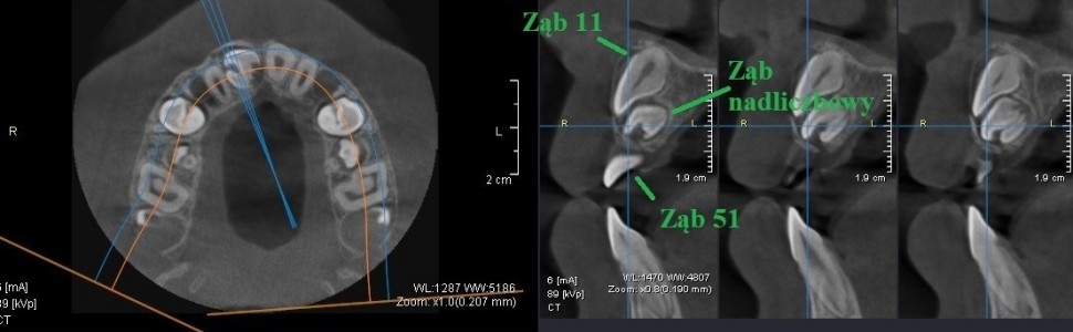 Zespołowe leczenie zatrzymania górnego zęba siecznego przyśrodkowego spowodowanego przez ząb nadliczbowy – opis przypadku