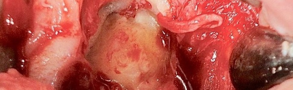Cementoblastoma – rzadki guz zębopochodny. Opis przypadku
