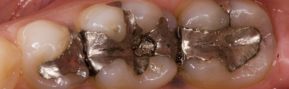 Badanie uwalniania rtęci z amalgamatów dentystycznych do roztworu sztucznej śliny – wstępne doniesienia