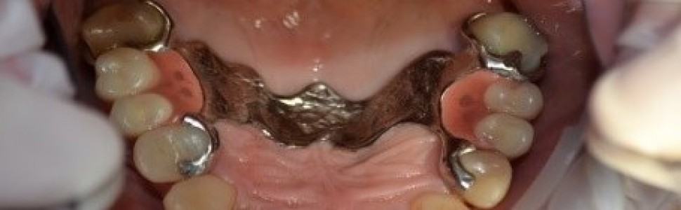 Patologiczne starcie zębów – odbudowa zwarcia, opis przypadku