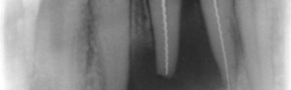 Leczenie endodontyczne zębów przed planowanym zabiegiem usunięcia torbieli korzeniowej – opis przypadku