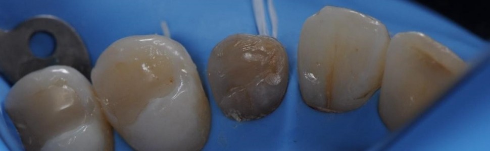 Zachowawcza odbudowa przetrwałego zęba mlecznego