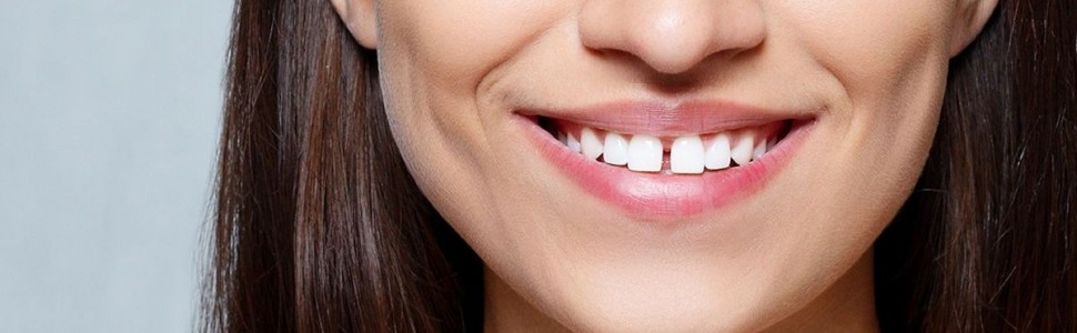 Zamknięcie diastemy z użyciem uniwersalnego kompozytu nanohybrydowego Harmonize™