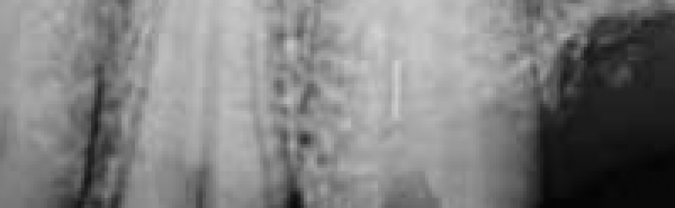 Złamane narzędzie kanałowe - powikłanie w endodoncji, z którym można sobie poradzić