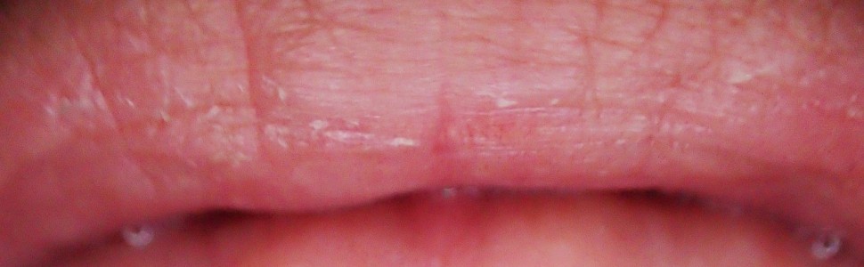 Perforacje jako powikłanie leczenia endodontycznego – postępowanie kliniczne