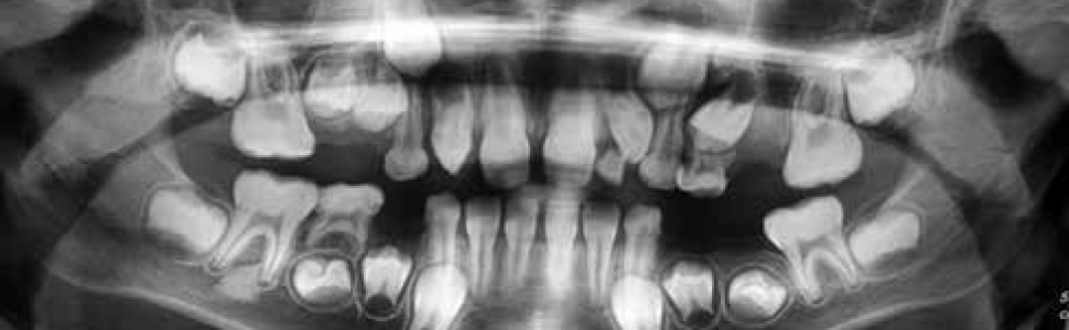 Leczenie techniką regeneracji wgłobionego zęba przyczynowego ropnia dołu nadkłowego