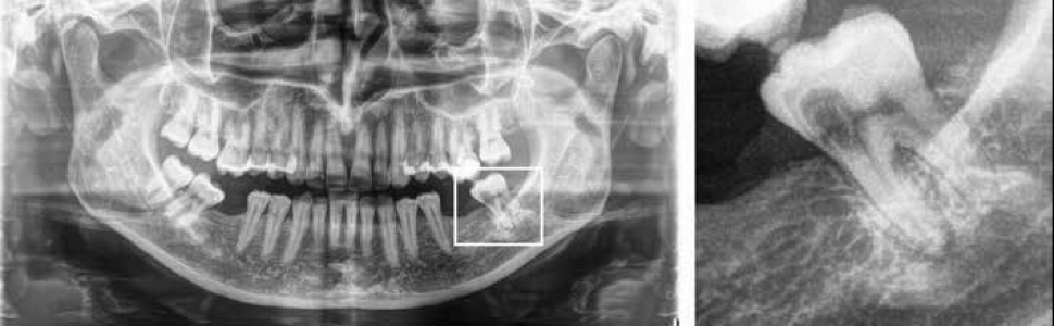 Inwazyjna resorpcja przyszyjkowa zęba 37