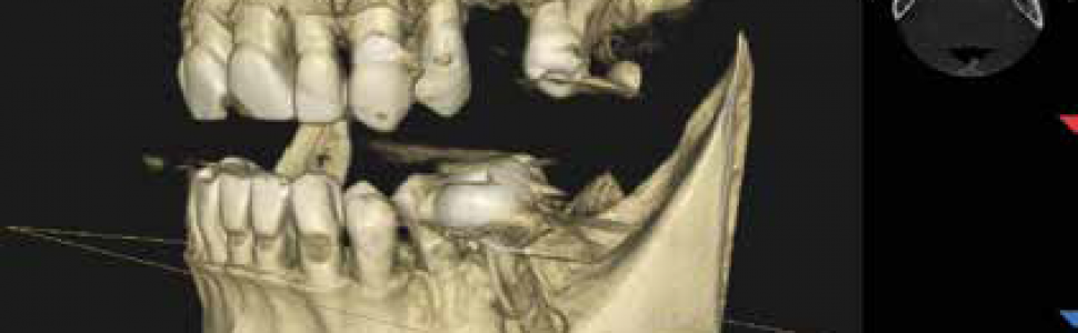 Powtórne leczenie kanałowe, dekompresja torbieli i jej późniejsze usunięcie ze sterowaną regeneracją kości, czyli krótka historia długiego leczenia zębów 35 i 36