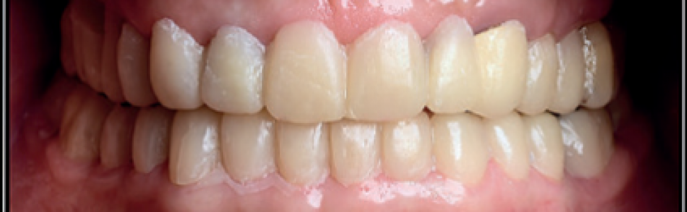 Wykonanie kompleksowej rekonstrukcji protetycznej w przebiegu osteoarthritis lewego stawu skroniowo‑żuchwowego w oparciu o diagnostykę obrazową – opis przypadku