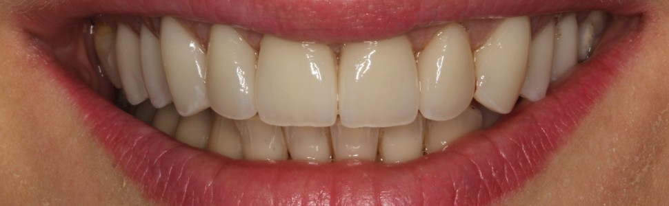 Rekonstrukcja estetyczna  uśmiechu za pomocą koron  i licówek pełnoceramicznych. Opis przypadku