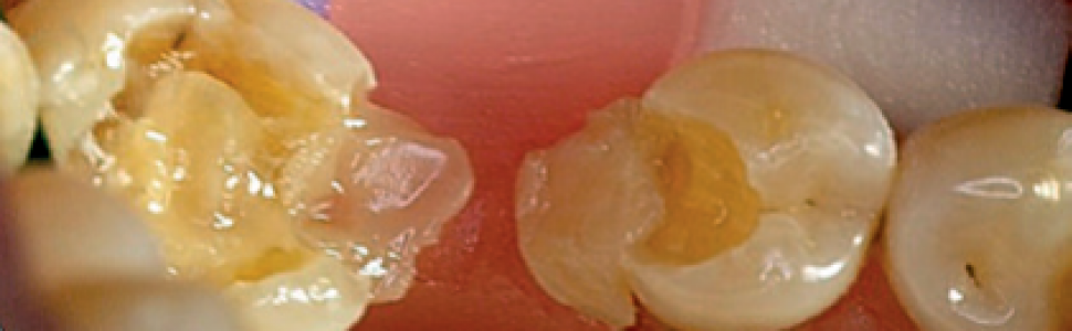 Most kompozytowy. Opis przypadku