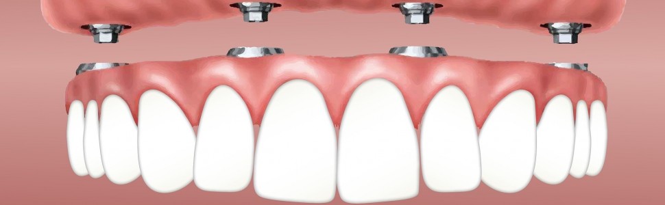 Zastosowanie protez typu  overdenture w leczeniu bezzębia. Przegląd piśmiennictwa