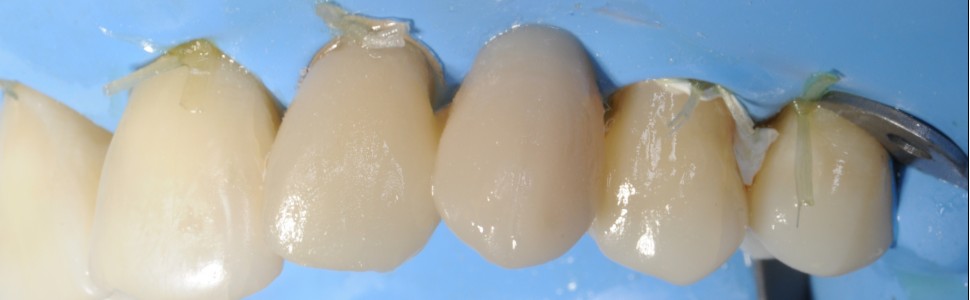 Natychmiastowa odbudowa kła szczęki  po utracie przetrwałego zęba mlecznego