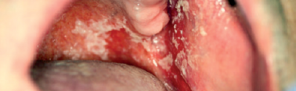 Kandydoza jamy ustnej. Część I: etiologia, klasyfikacja, obraz kliniczny