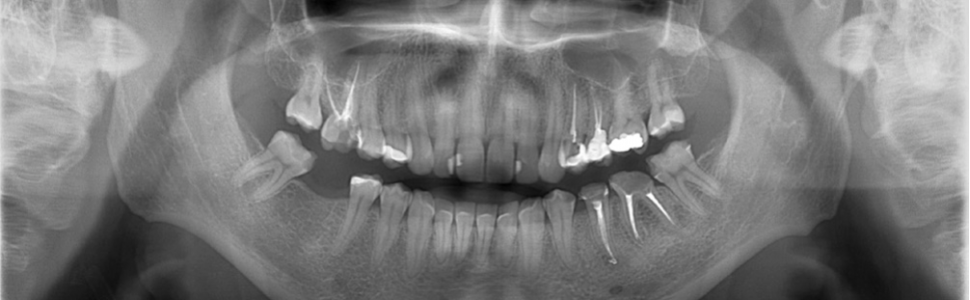 Ponowne leczenie endodontyczne  zębów przedtrzonowych z kanałami  bocznymi i deltą korzeniową. Opis dwóch przypadków