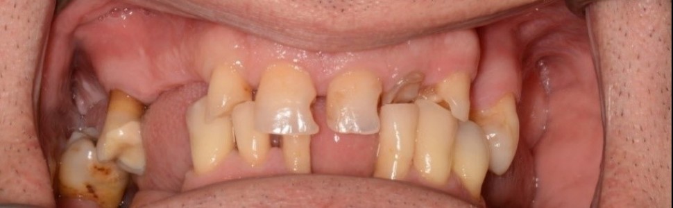 Kompleksowa rehabilitacja zachowawczo-protetyczna pacjenta z zaburzeniami zwarcia – opis przypadku