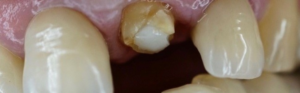 Adhezja w stomatologii rekonstrukcyjnej