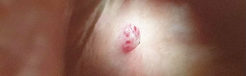 Leczenie naczyniaka jamistego tętnicy podniebiennej laserem dużej mocy- opis przypadku