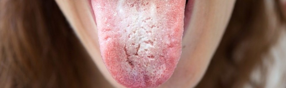 Kandydoza jamy ustnej. Część II: diagnostyka i leczenie