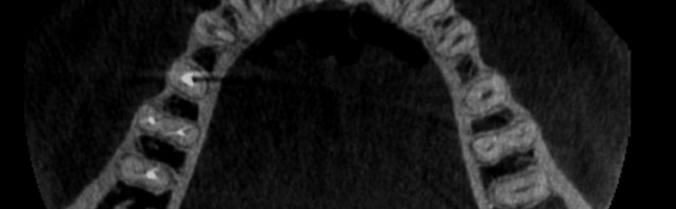 SPECJALISTA RADZI: Odbudowa protetyczna zęba trzonowego z kanałem typu C