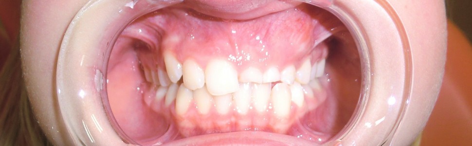 Zęby nadliczbowe – przegląd piśmiennictwa i opis dwóch przypadków