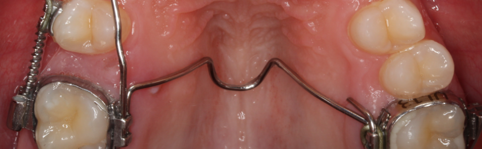 Odtworzenie całkowitego braku miejsca dla drugiego zęba  przedtrzonowego w szczęce za pomocą stałych aparatów grubołukowych. Opis przypadku