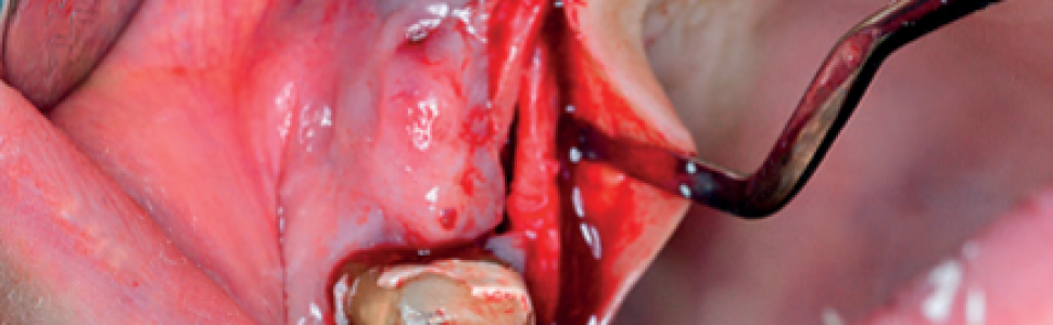 Wykorzystanie autogennej tkanki w procedurach augmentacyjnych zwiększających szerokość i objętość tkanek skeratynizowanych przed implantacją 