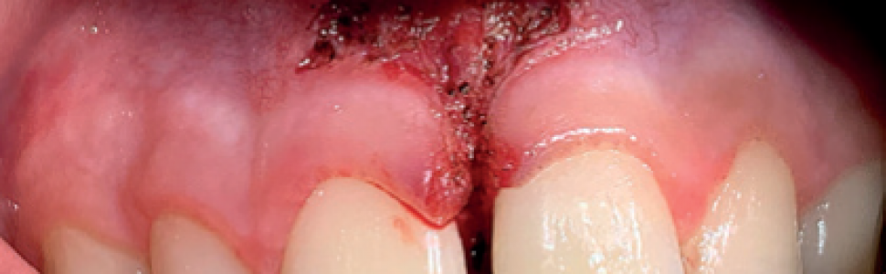 Zabieg frenulektomii techniką mieszaną. Opis przypadku