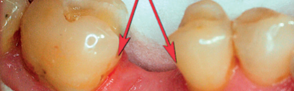Zastosowanie materiału złożonego Boston i Włókien Kompozytowych. Opis przypadku