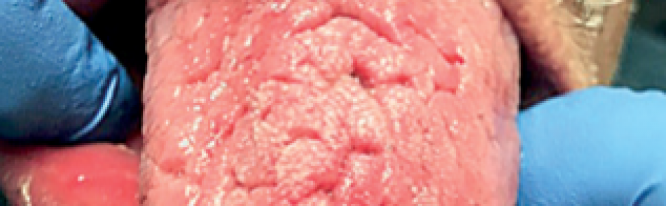 Zespół Melkerssona-Rosenthala – problemy z diagnostyką i leczeniem. Opis przypadku