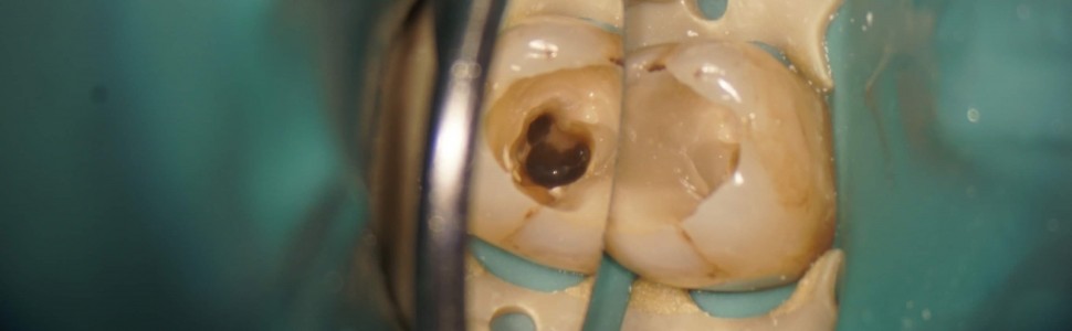 SPECJALISTA RADZI: Leczenie endodontyczne zęba z kanałem typu C