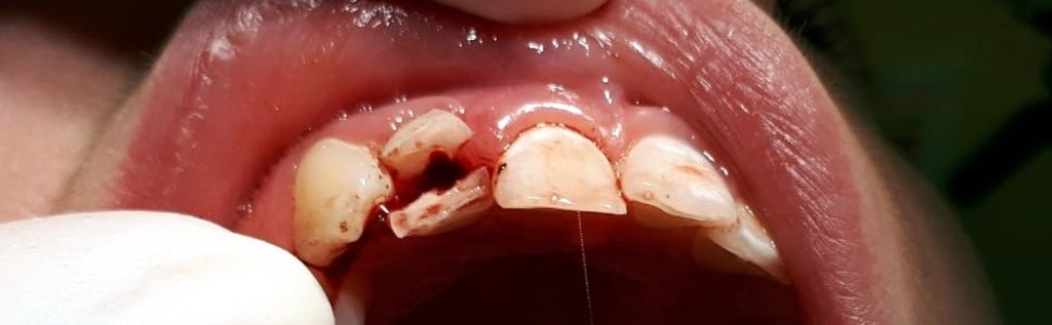 Ekstruzja chirurgiczna jako sposób postępowania w złamaniach koronowo-korzeniowych u pacjentów w wieku rozwojowym. Opis przypadku 