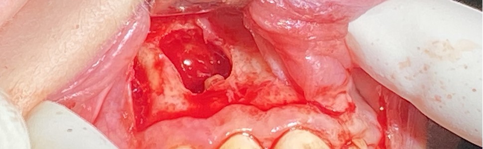 Resekcja wierzchołka korzenia z zastosowaniem L-PRF. Opis przypadków