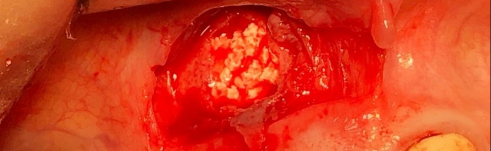 Chirurgiczne leczenie torbieli korzeniowej z zastosowaniem lasera Er,Cr:YAG. Opis przypadku