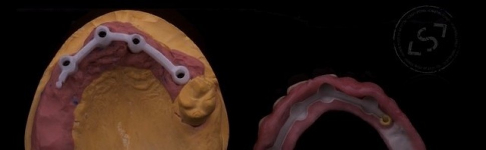 Protezy typu overdenture osadzone na implantach za pomocą precyzyjnych elementów retencyjnych - przegląd i porównanie dostępnych rozwiązań