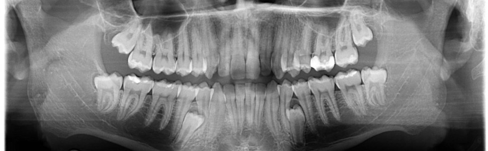 Dodatkowe zęby przedtrzonowe – opis przypadku